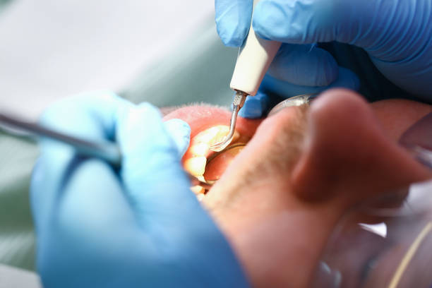 Best Knocked-Out Tooth (Avulsed Tooth) Treatment in Pimlico, SC
